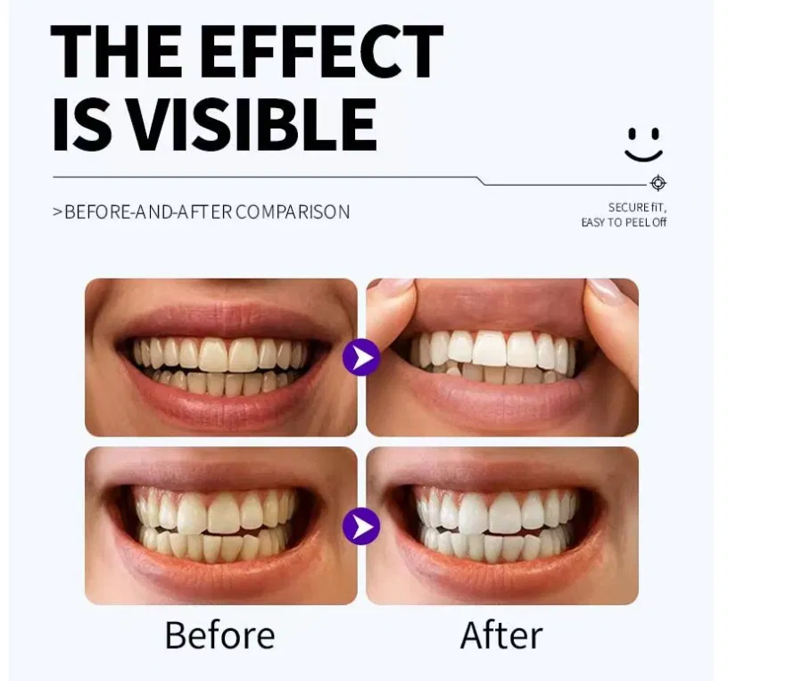 Before and after teeth whitening comparison